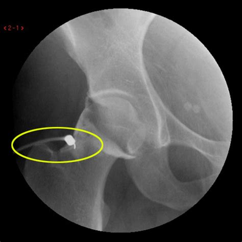 MRI Arthrogram Hip: Rule Out Labral Tear | Cedars-Sinai