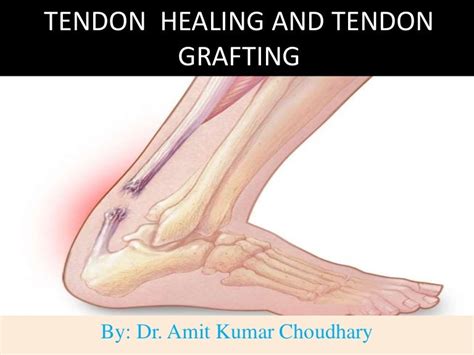 Tendon healing and tendon grafting