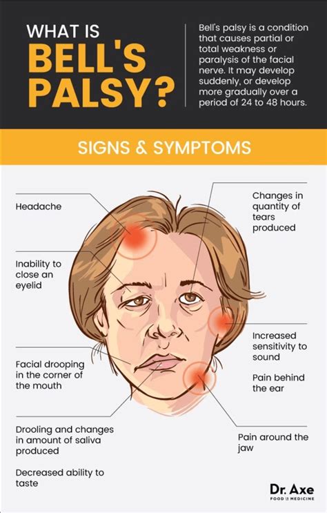 Bells Palsy Facial Nerve Bells Palsy Medical Knowledge | The Best Porn ...