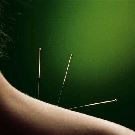 Unlocking Relief: Exploring Acupuncture's Role in Easing Frozen ...