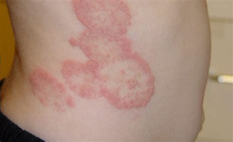 6 Painful Fungal Infections: Causes, Symptoms, and Treatments