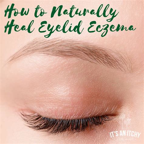 How to Naturally Heal Eyelid Eczema | It's an Itchy Little World