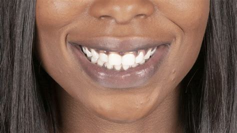 What Causes Black Gums? | Stanley Dentistry