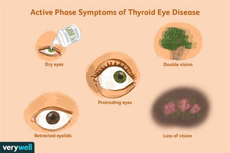 What Are Thyroid Eye Disease Symptoms - Infoupdate.org