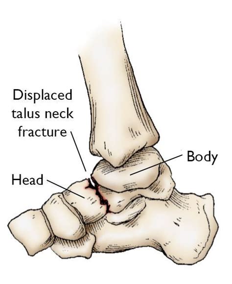 كسر عظمة الثالوث (الكاحل) Talus Talus fracture | الدكتور مازن كردية