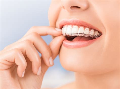 How long does it take to start seeing Invisalign results?