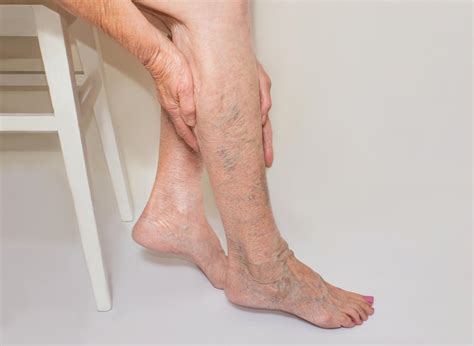 How To Avoid Getting Varicose Veins - Memberfeeling16