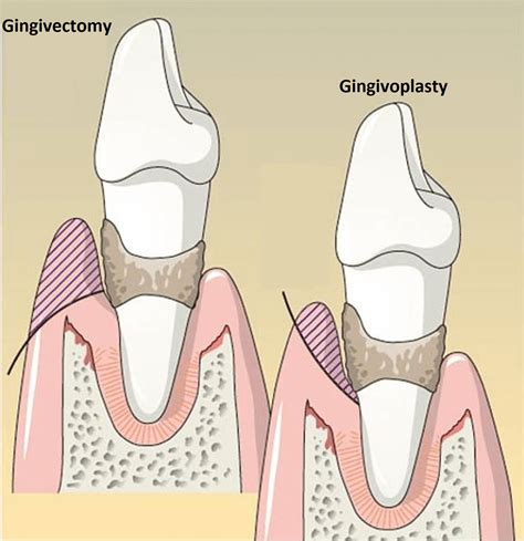 What is the difference between gingivectomy and gingivoplasty? | News ...