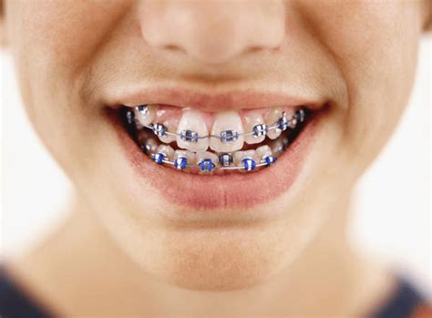 How Much Do Braces Cost? | Szymanowski Orthodontics | Dr. Damon