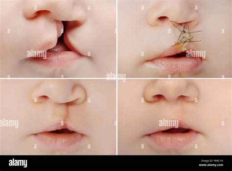 Cleft palate before after hi-res stock photography and images - Alamy