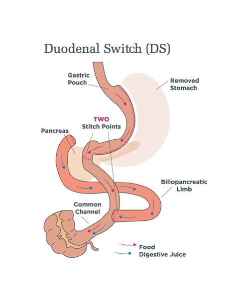 Duodenal Switch Procedures - SADI-S and Classic DS | UT Health Tyler ...