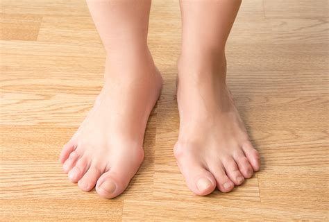 Bunions: Home Therapies, Self-Care and Foot Exercises