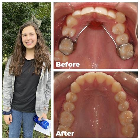 Get Clear Braces That Match The Color Of Your Teeth