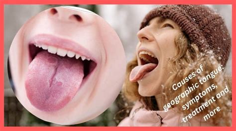 Causes of geographic tongue: symptoms, treatment and more