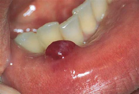 Mucocele Floor Of Mouth