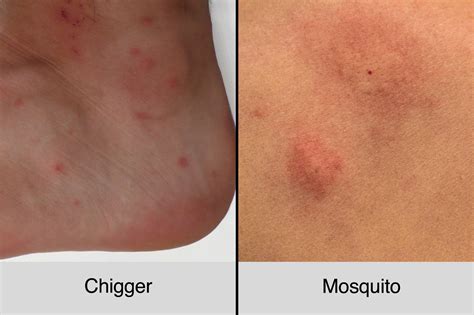 Chigger Bites Vs. Mosquito Bites: How to Tell the Difference | The Healthy