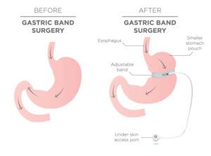 Lap Band Removal | Weight Loss Surgery Revision | Seattle, WA