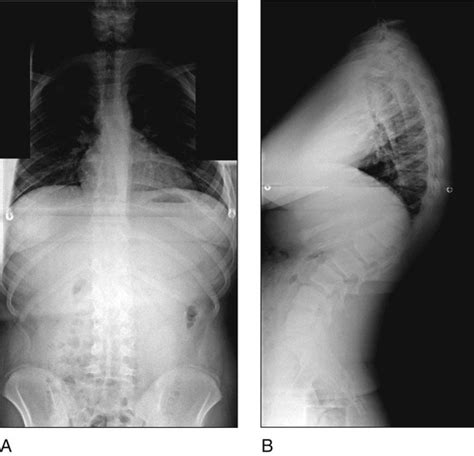 56: Posterior Surgical Treatment for Scheuermann’s Kyphosis ...