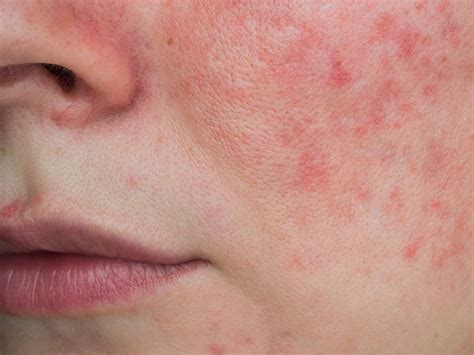 Lupus Rash vs. Rosacea: What’s Causing My Butterfly Rash?