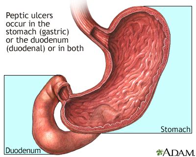 Peptic Ulcer Symptoms, Doctors, Treatments, Advances & More | MediFind