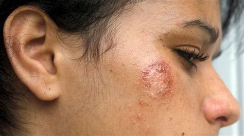 Is It Impetigo or Something Else? 8 Distinguishing Factors | Everyday ...