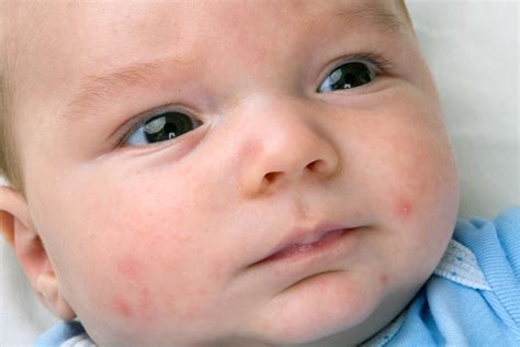 Is it a Rash or Baby Acne? | Healthfully