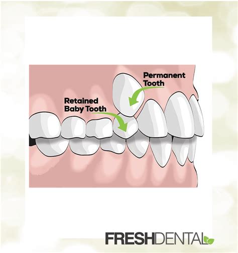 Tooth Extractions - FRESH Dental NC | Your Local Dentist