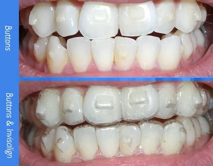 Find Out Why Some Invisalign Users Need Attachments