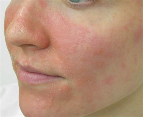 Facial Eczema: Triggers and Dealing Methods | New Health Advisor