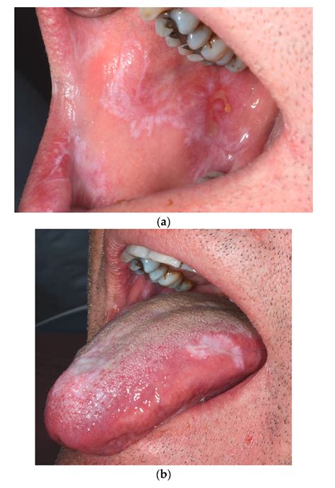 Dermatopathology | Free Full-Text | Allopurinol-Induced Oral Lichenoid ...