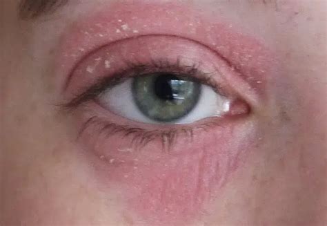 This Miracle Cream Got Rid Of My Eye Eczema [with Photos]