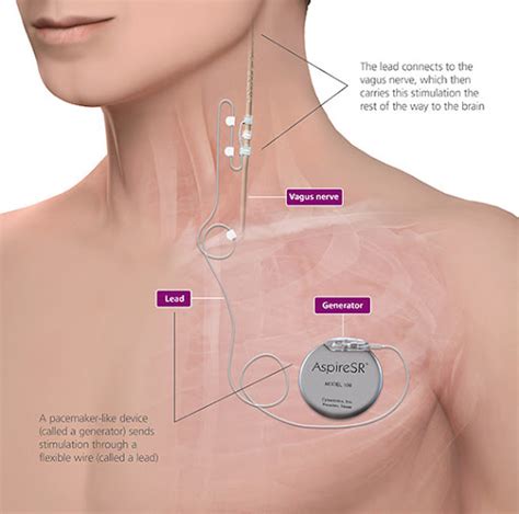 Neurology : Vagus nerve stimulation