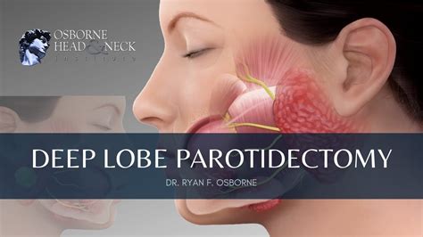 Deep Lobe Parotidectomy Procedure Explained By Dr. Ryan Osborne of ...