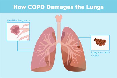 COPD and Arthritis: What’s the Connection?