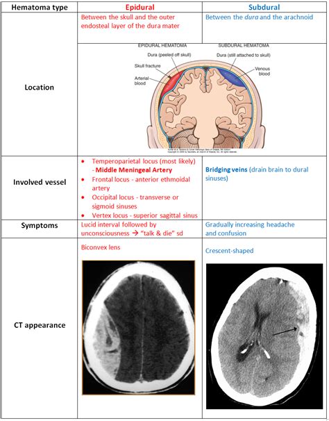 My Notes for USMLE — EPIDURAL & SUBDURAL HEMATOMA