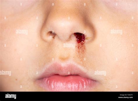 Nose bleeding child hi-res stock photography and images - Alamy