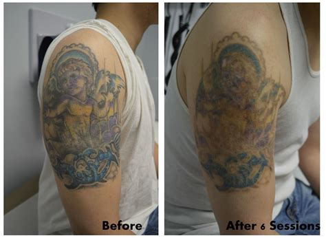 Full color tattoo removal after 6 sessions! Look at that fading ...