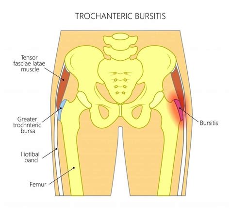 4 Best Hip Bursitis Exercises For Seniors | Exercises To Avoid