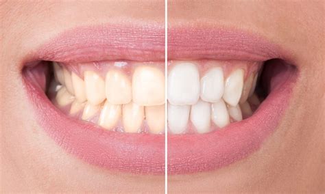 Teeth Whitening - Southern Dental