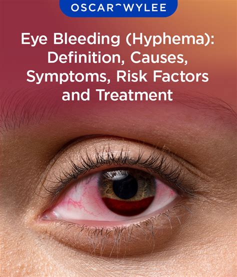 Eye Bleeding (Hyphema): Definition, Causes, Symptoms, Risk Factor and ...