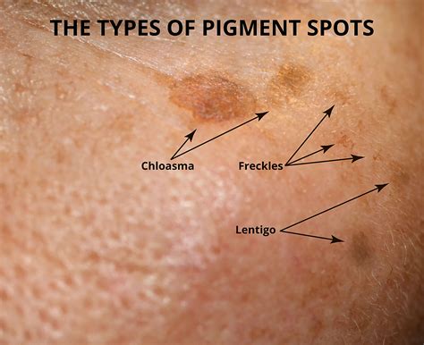 salami mineral Crow cause of brown spots on skin idiom society replace