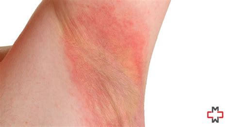 Armpit Rash: Causes, Treatment and Prevention