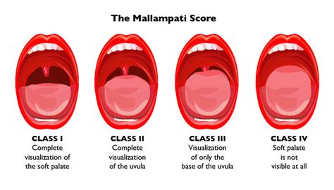 Understanding the Mallampati score - The Clinical Advisor