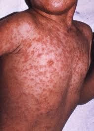 Measles - Important Information - Gila River Health Care