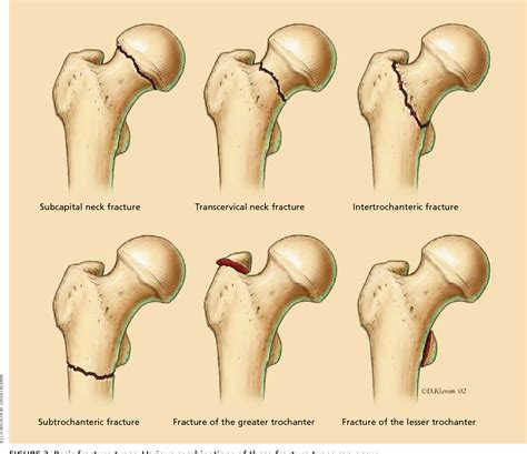 Figure 3 from Hip fractures in adults. | Semantic Scholar