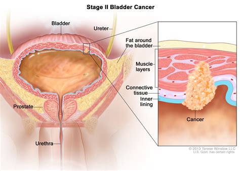 Bladder Cancer Staging