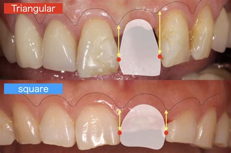 Interproximal papilla for single-tooth implant restorations – risk factors