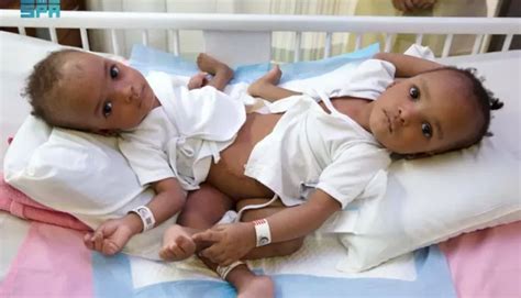 Surgery to separate Nigerian siamese twins begins in Saudi Arabia ...