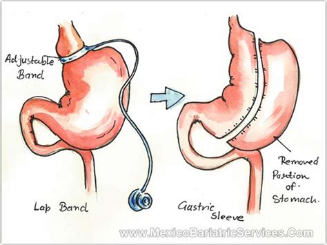 Lap Band to Gastric Sleeve Revision-Tijuana Mexico