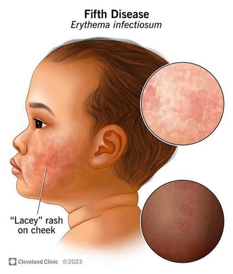 Erythema Infectiosum - MEDizzy